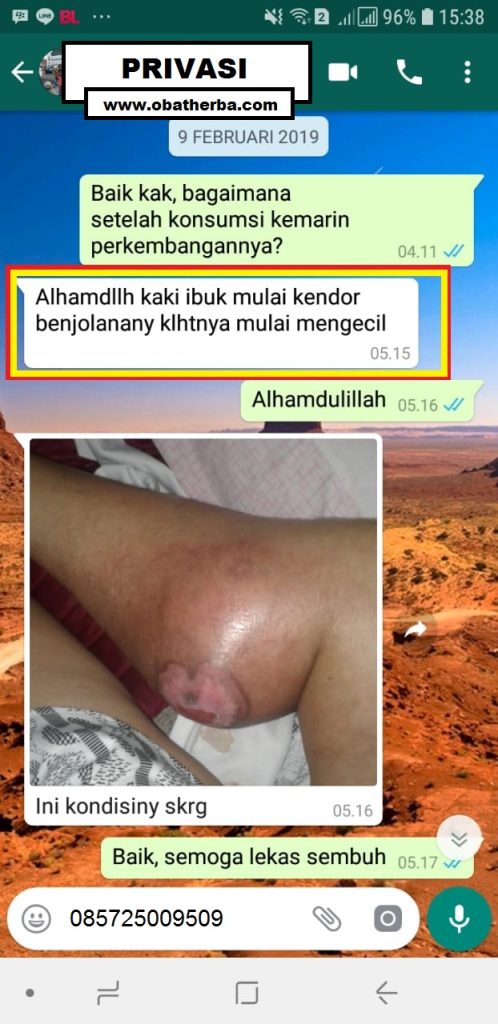 benjolan tumor kanker di kaki