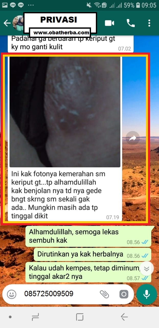 benjolan tumor payudara